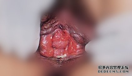 如何治疗淋病呢