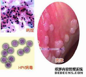 尖锐湿疣的临床表现