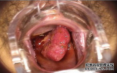 尖锐湿疣危害性在哪里呢